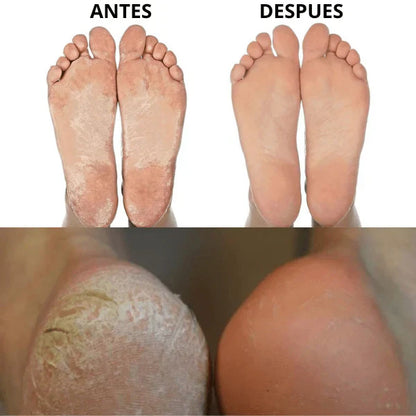 Removedor de Callos Eléctrico – Pies suaves al instante